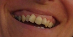 mes dents